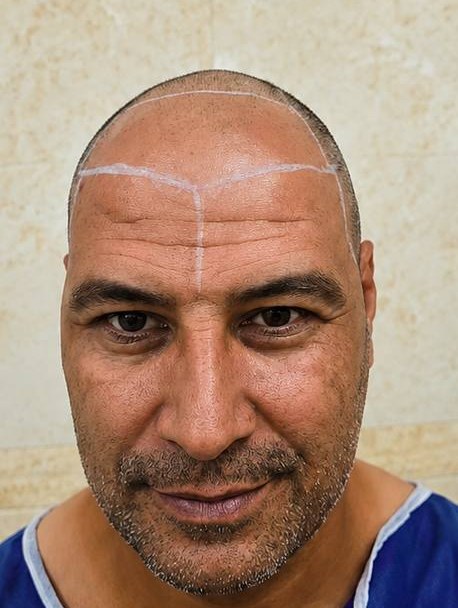 کاشت مو — قبل