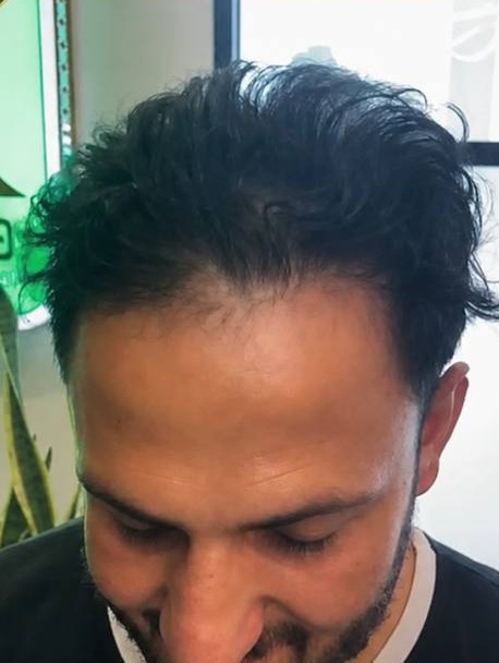 کاشت مو — قبل