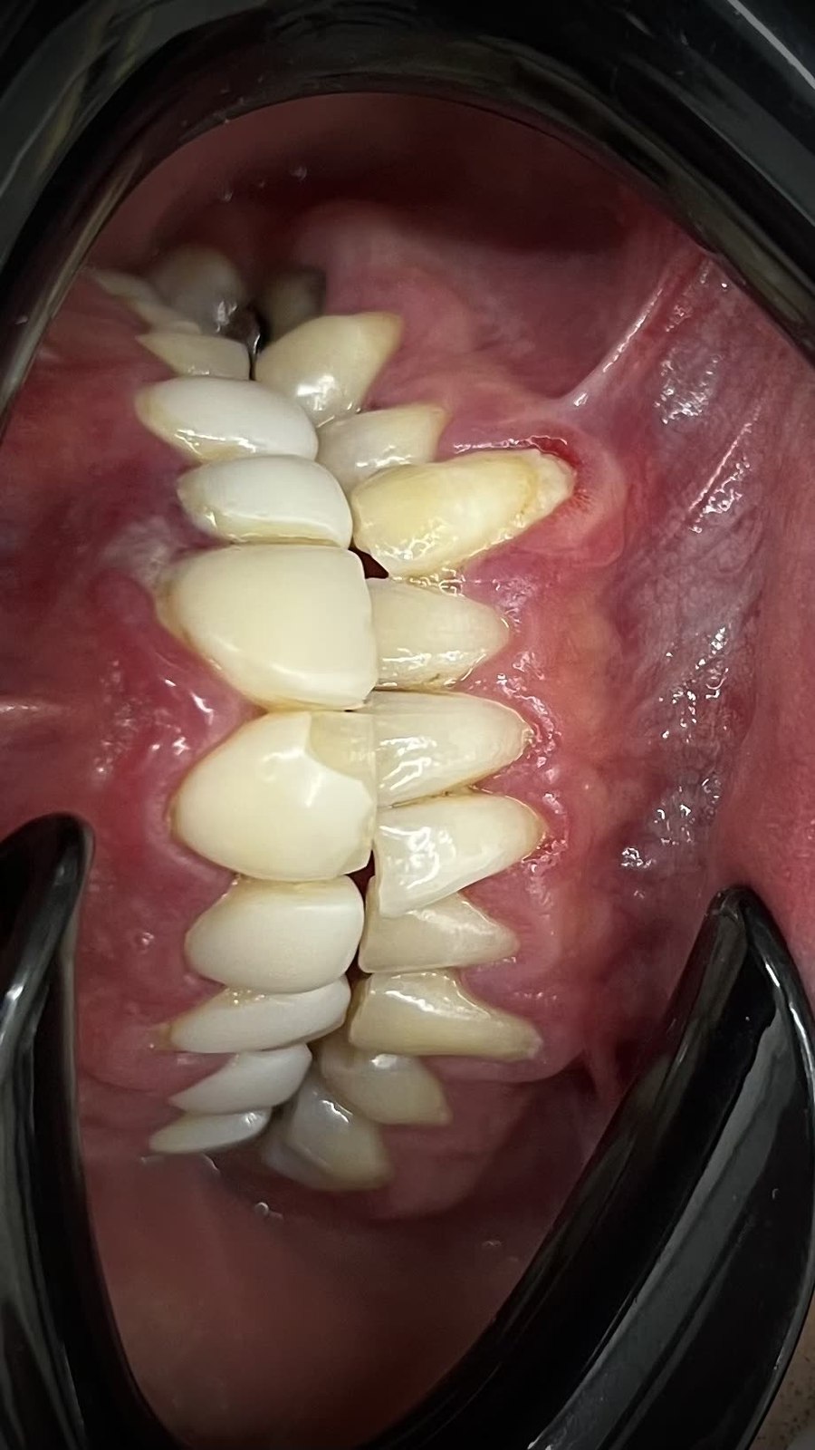 طراحی لبخند — قبل